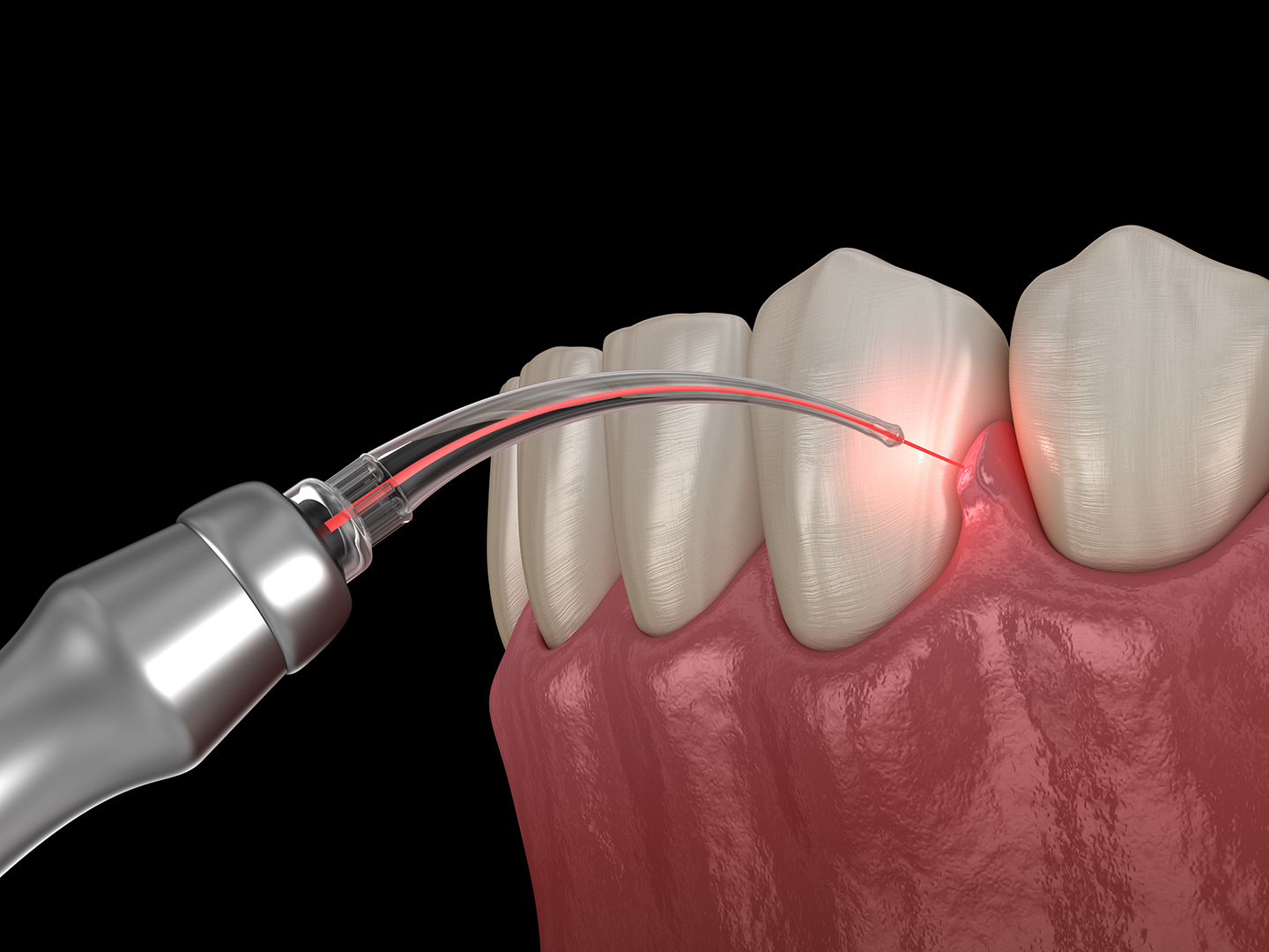 Gum Bleaching - Waldron Dental Clinic
