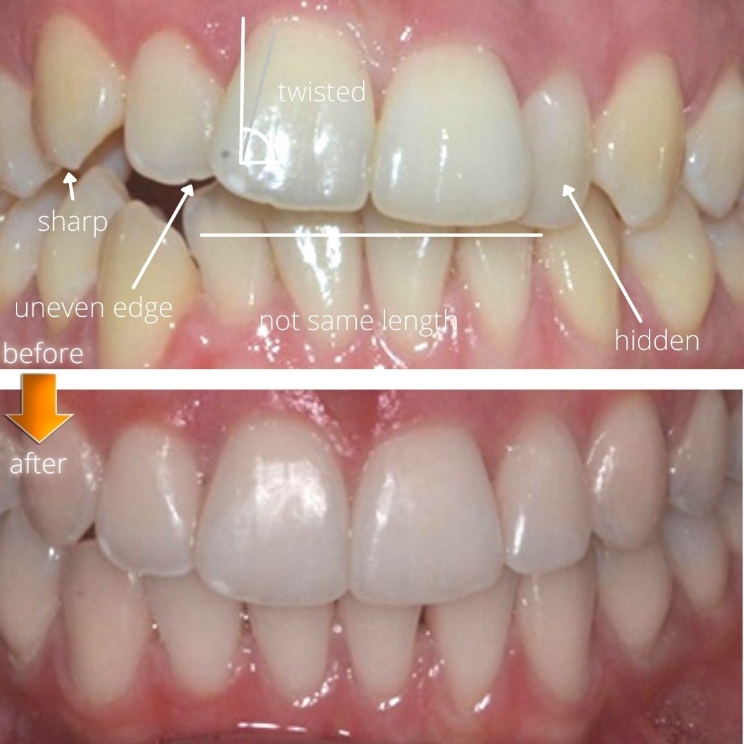 Cosmetic dental veneer bonding and orthodontics