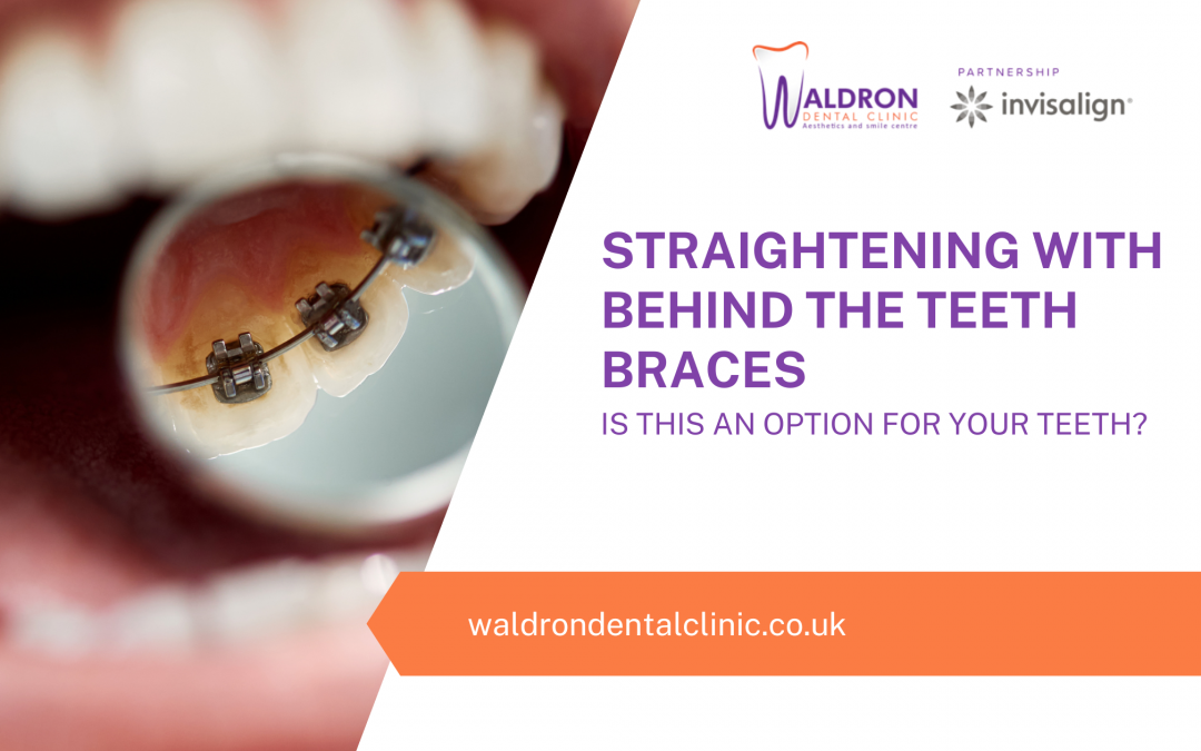 Straightening With Behind The Teeth Braces – Is This An Option For Your Teeth?