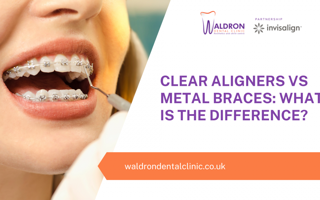 Clear Aligners Vs Metal Braces: What Is The Difference?